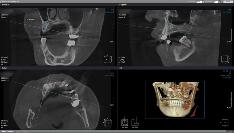 임플란트 브릿지와 크라운 수복으로 치아 기능을 회복시킨 증례 관련 이미지 11