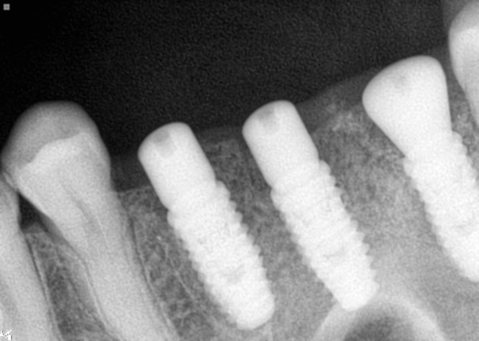 40대 임플란트 치료 케이스 상악동거상술 골이식까지 관련 이미지 7