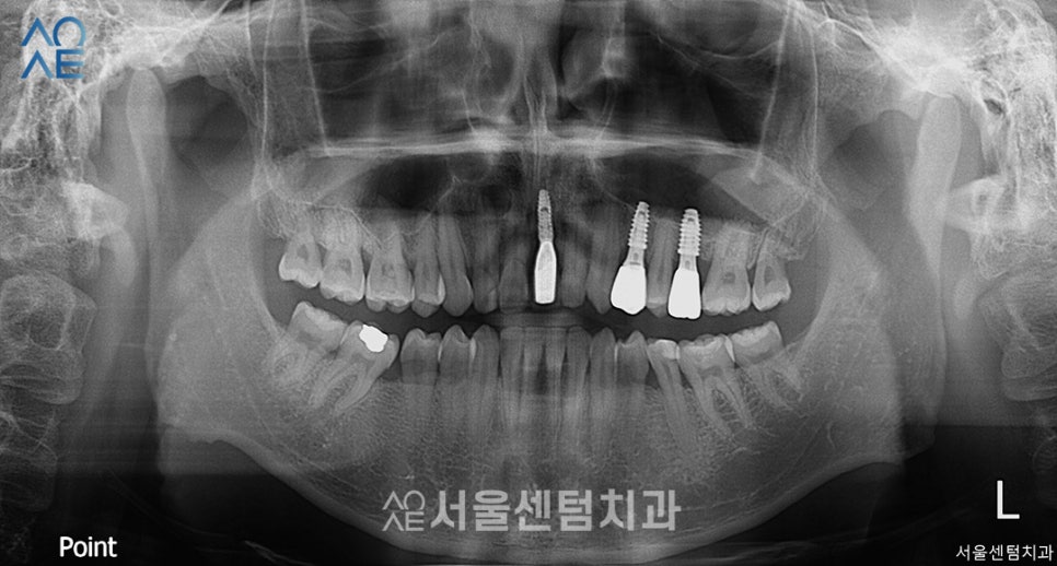 앞니 임플란트기간 실제 수술사례로 알려드려요 관련 이미지 5