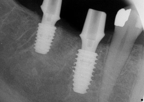 신사역치과 발치후 임플란트 시술과정 30대 남성 케이스 관련 이미지 5