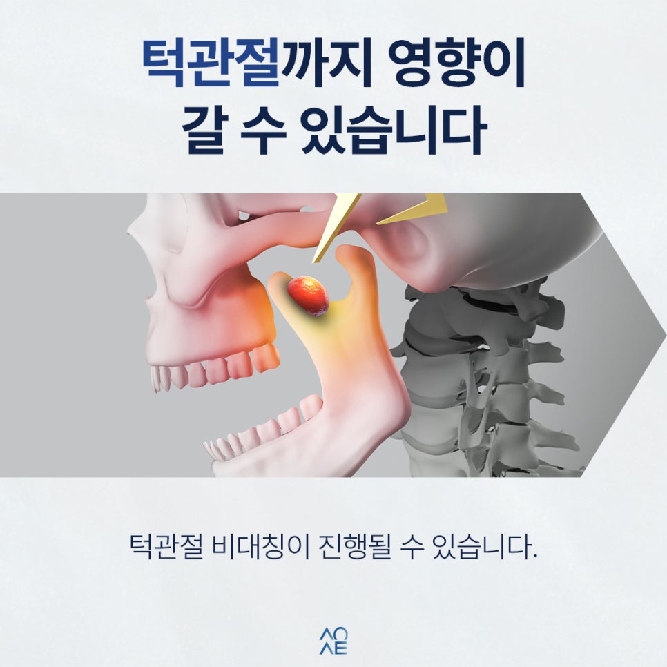 한쪽으로만 씹으면 생기는 일 나중에 임플란트까지 갈 수 있습니다 관련 이미지 5