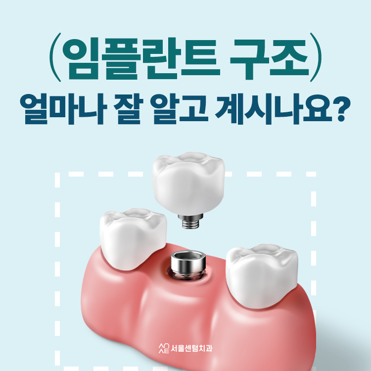 임플란트 구조 하나하나 뜯어보면 알 수 있는 원리 관련 이미지 1