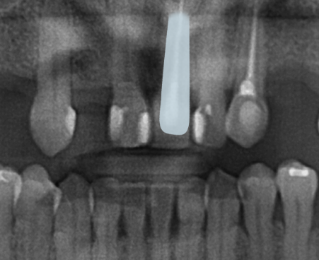 잠원역치과 임플란트 보험 실비 가능하나요? 관련 이미지 11