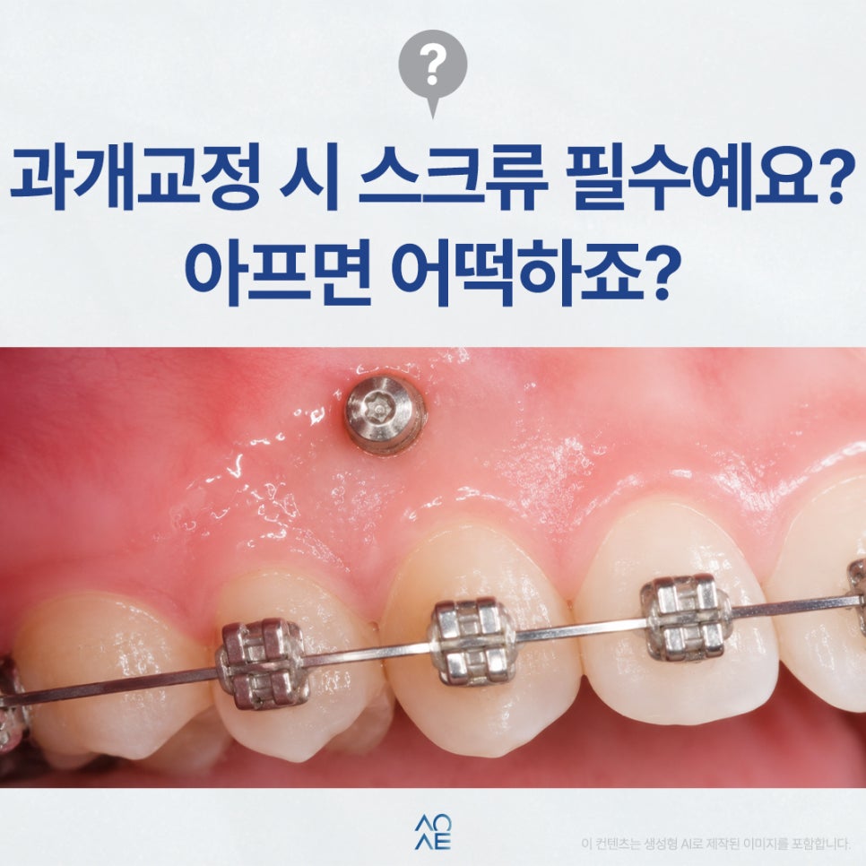 Are Orthodontic Screws Necessary for Correcting an Overbite? They Look Painful image 1