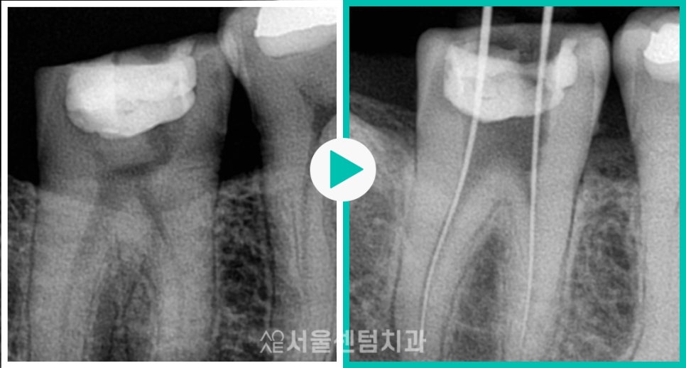 Explaining the Root Canal Treatment Process with Actual Dental Photos image 3