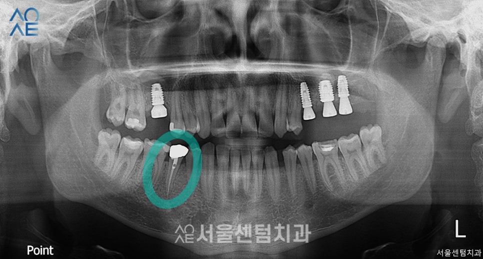 20대임플란트후기 진행과정부터 상세히 관련 이미지 4