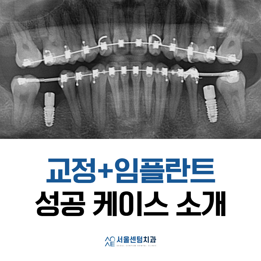 교정임플란트 모두 맡겨주신 결과 관련 이미지 7