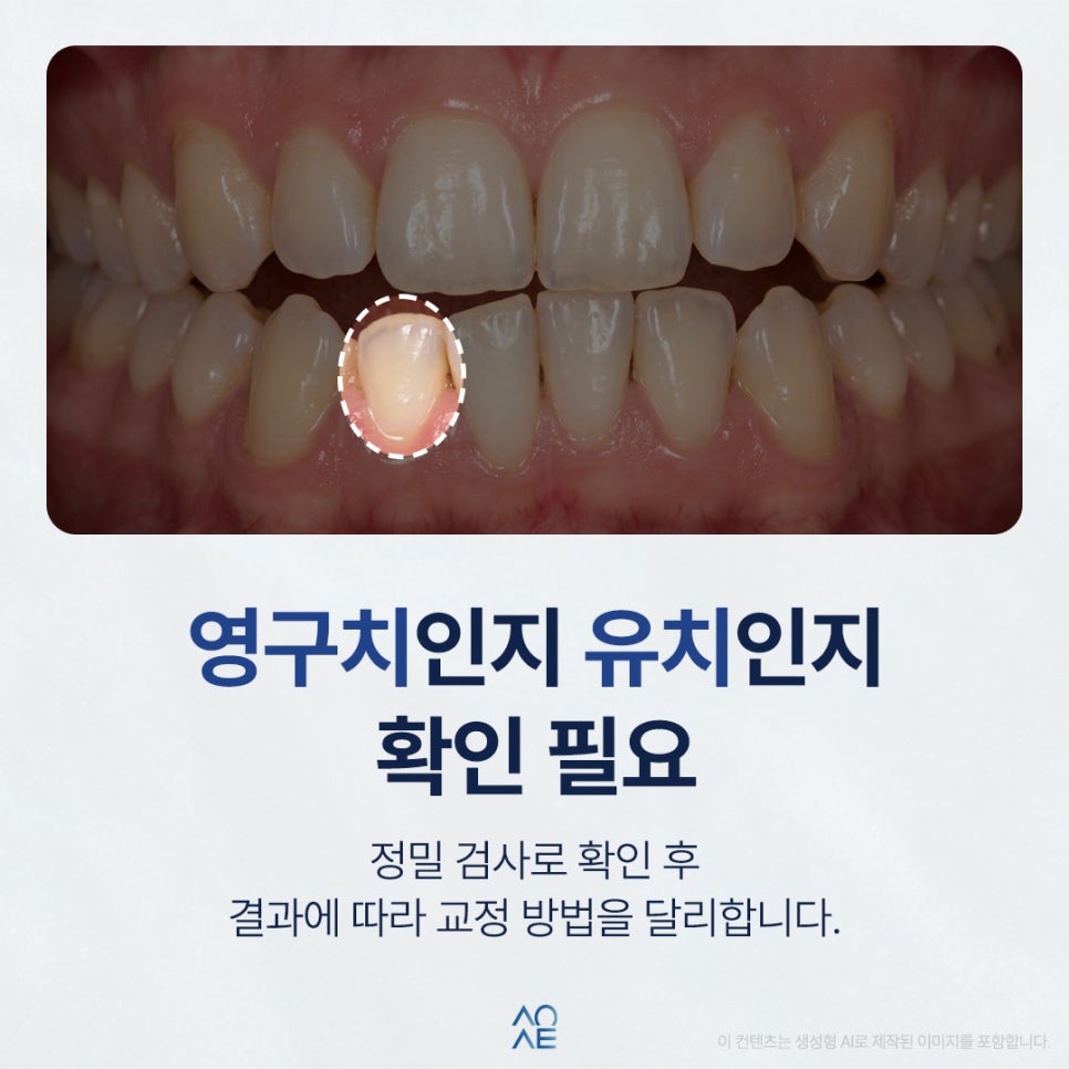 Do I Need Full Orthodontic Treatment After Extracting a Crowded Tooth? image 2