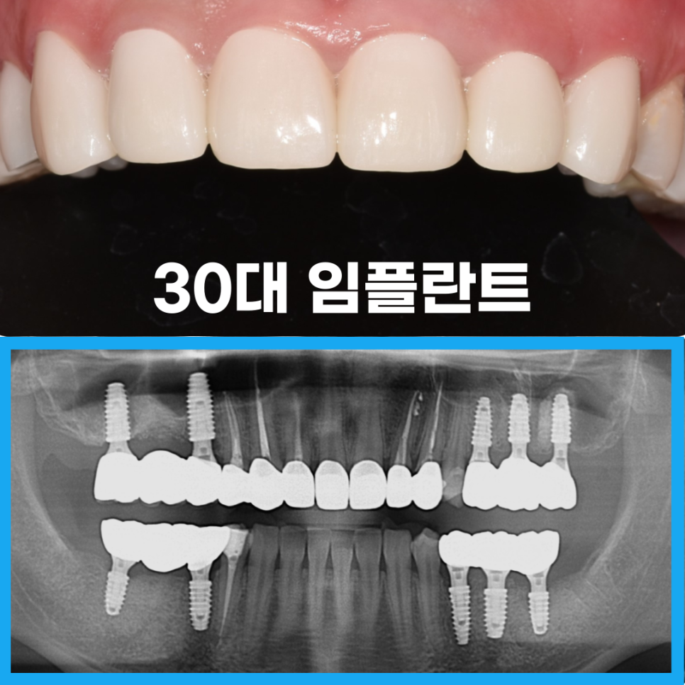 신사역주말치과 갑자기 어금니 이빨 부러졌다면 관련 이미지 12