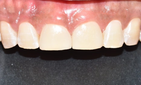 치과 마취 종류 풀리는 시간 주의사항에 대해서 관련 이미지 10