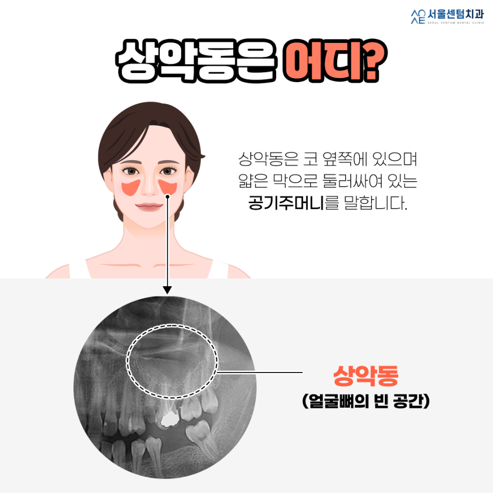 상악동거상술 주의사항 반드시 체크해야할 것 관련 이미지 1