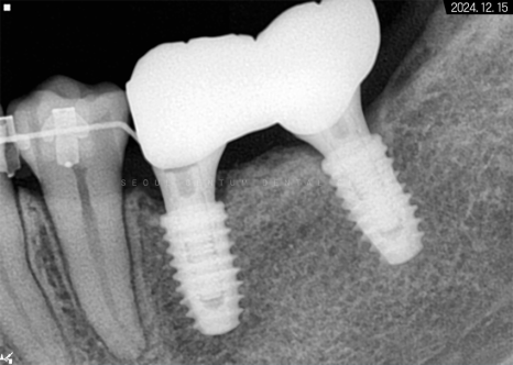 돌출입 및 신경치료와 임플란트 식립 동시 진행 증례 관련 이미지 25