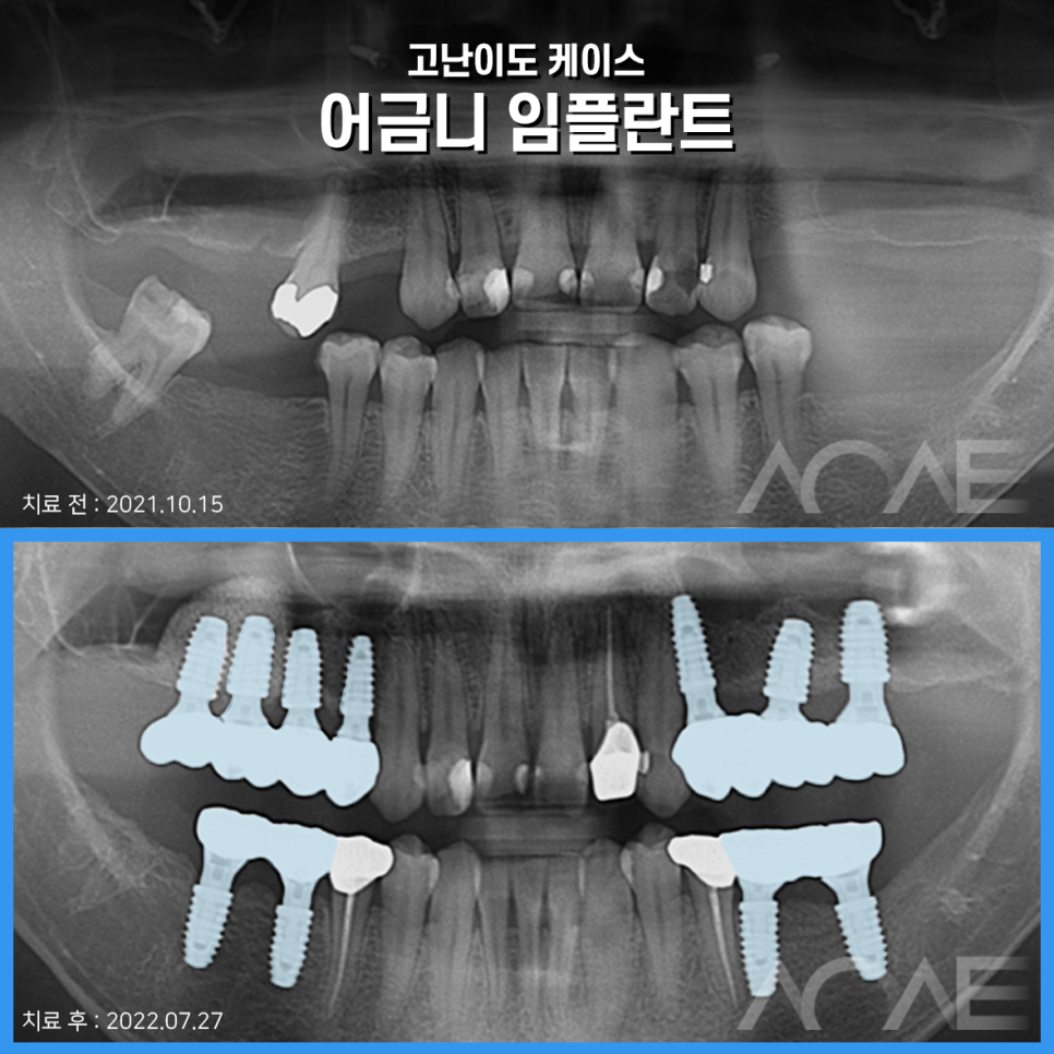 임플란트 가격 차이 다른 이유 관련 이미지 6
