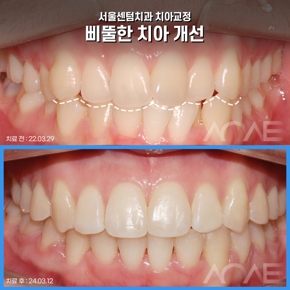 강남치아교정잘하는 교정 고무줄 통증 주의사항 관련 이미지 8