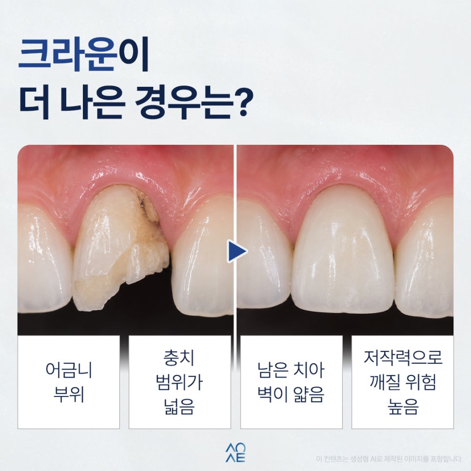 신경치료 후 크라운이랑 레진 중에 뭐가 더 낫나요? 관련 이미지 3