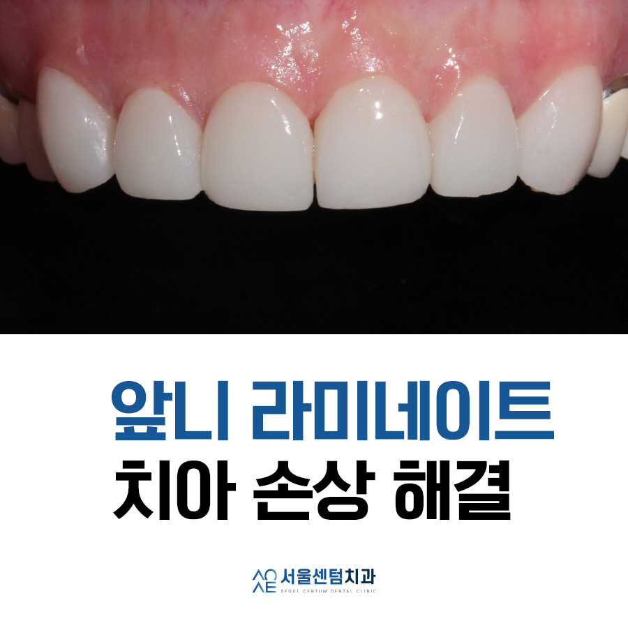 라미네이트 앞니 깨짐과 마모 해소한 증례 살펴보기 관련 이미지 6