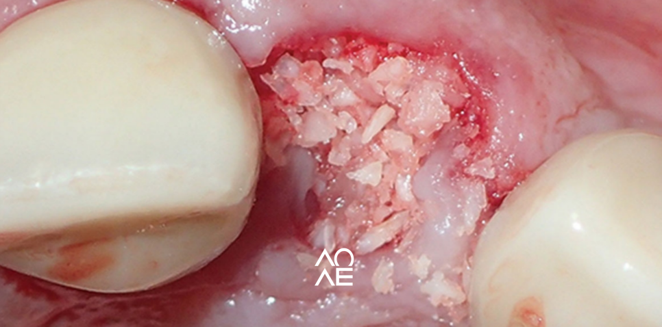 임플란트 뼈이식 필요한 경우 기간은? 관련 이미지 2