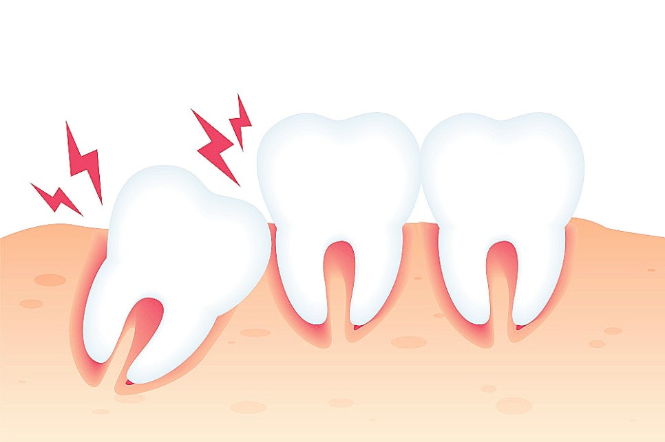 사랑니 발치 가글로 헥사메딘 써도 될까? 관련 이미지 3