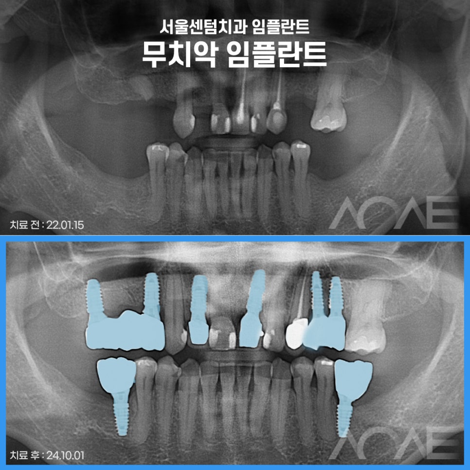 잠원역치과 임플란트 보험 실비 가능하나요? 관련 이미지 9