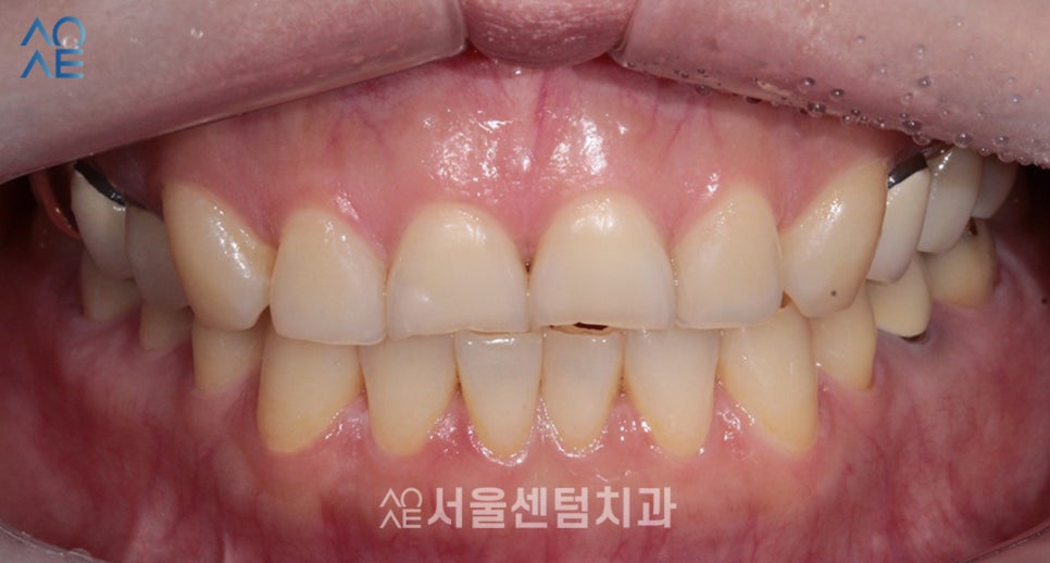 라미네이트 앞니 깨짐과 마모 해소한 증례 살펴보기 관련 이미지 3