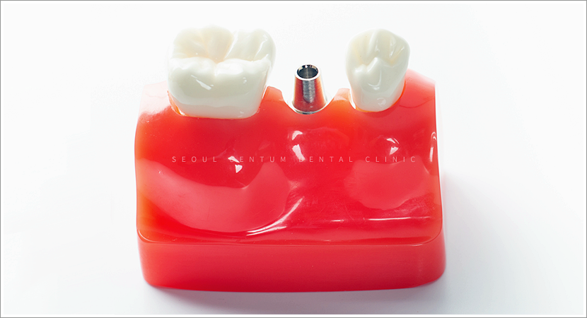 임플란트2차수술과정 언제 필요한지 핵심만 짚어보기 관련 이미지 6