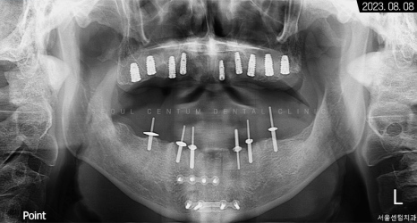 전체임플란트 기간 예상보다 줄어들 수 있는 방법과 증례 공개 관련 이미지 9