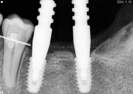 돌출입 및 신경치료와 임플란트 식립 동시 진행 증례 관련 이미지 21