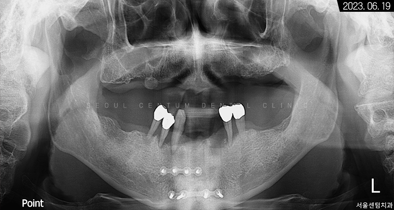 전체임플란트 기간 예상보다 줄어들 수 있는 방법과 증례 공개 관련 이미지 4