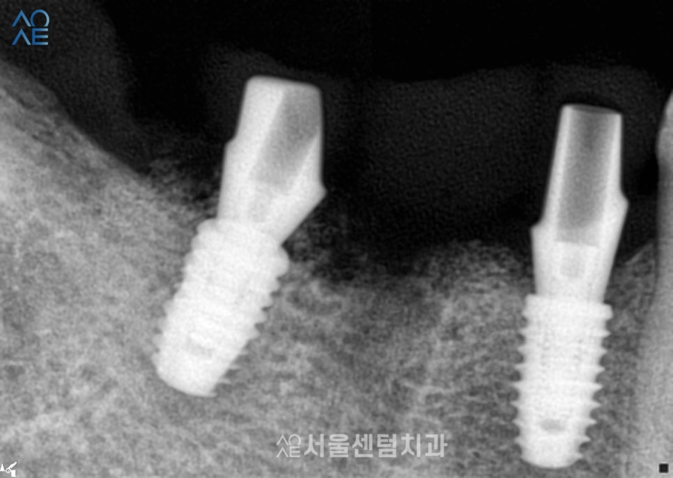 20대임플란트 처음이라 두렵다면 관련 이미지 3