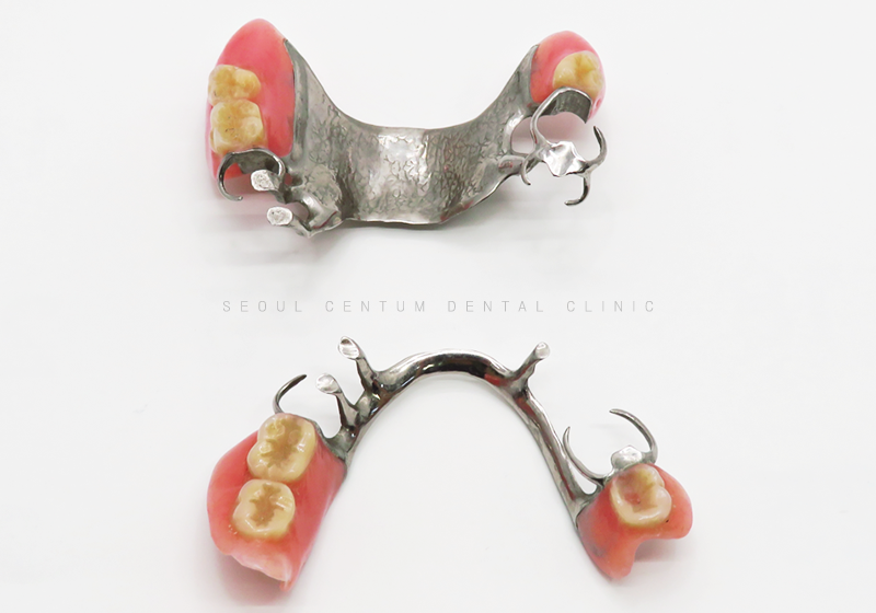 틀니임플란트 주의사항 알면 장점을 더 누릴 수 있어요 관련 이미지 2