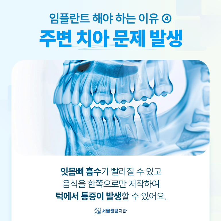 임플란트 안하면 추후 이런 결과가 발생할지도 관련 이미지 5