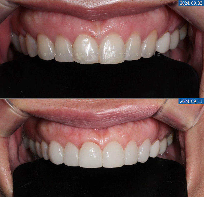 라미네이트전후 치아의 가지런한 정도와 밝기 차이 확인하기 관련 이미지 11