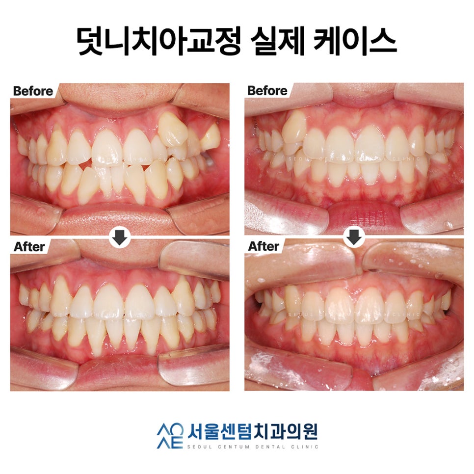 Explaining Orthodontic Treatment for Snaggletooth with Real Photos image 1
