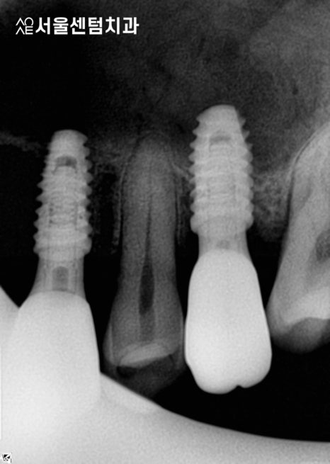 앞니 임플란트기간 실제 수술사례로 알려드려요 관련 이미지 4