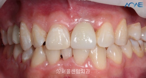 당일임플란트 상담부터 풀과정 공개 관련 이미지 10