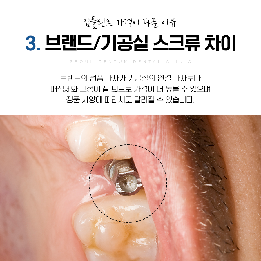 임플란트1개가격 어느 치과든 상관없이 천차만별인 이유 6가지 관련 이미지 7