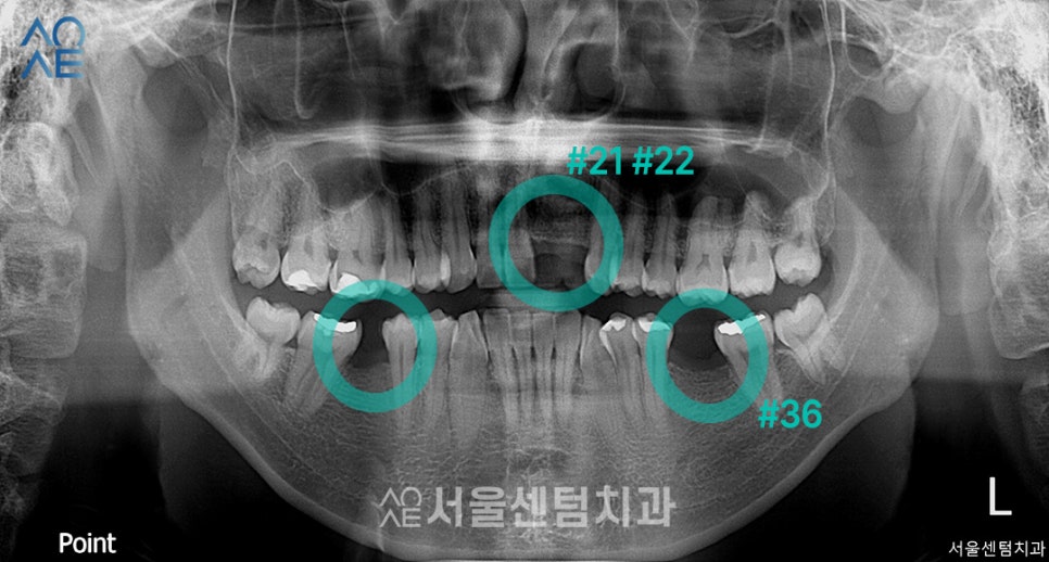 앞니 임플란트 후기 실제사례 보여드려요 관련 이미지 1