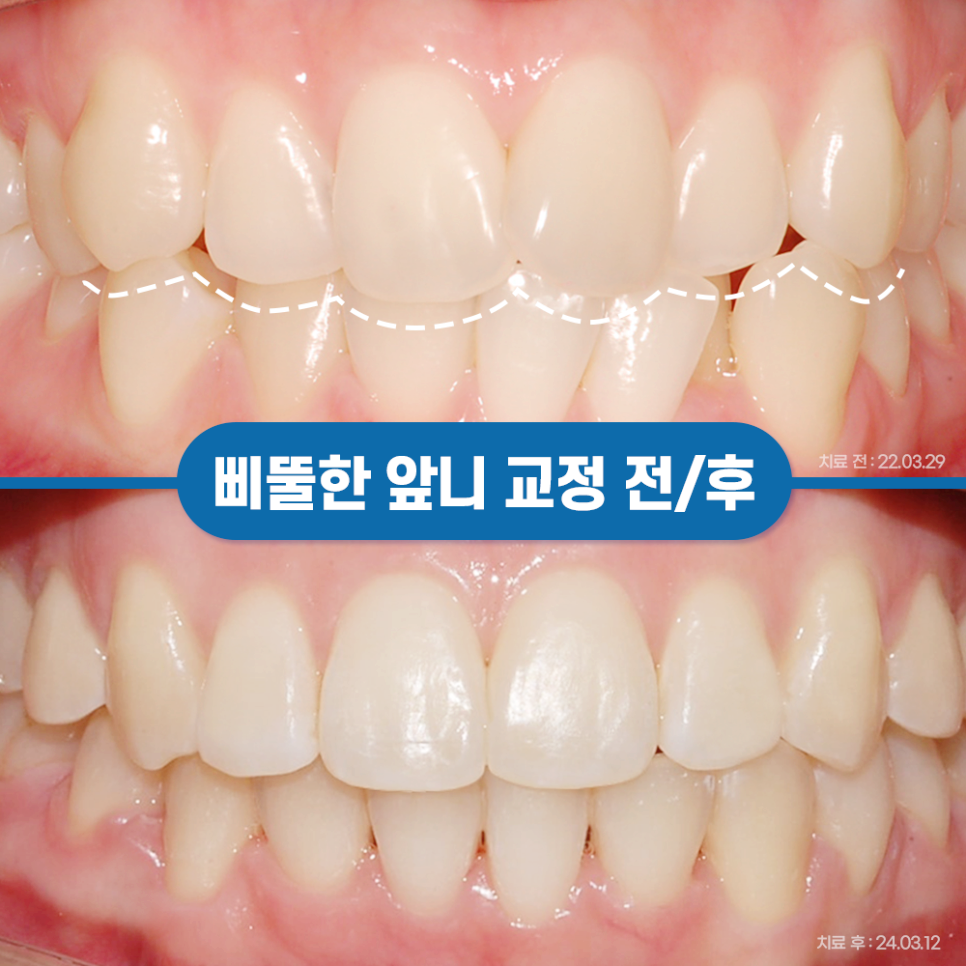 총생 앞니 덧니 발치 후 치아교정? 관련 이미지 10