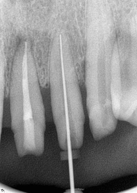 임플란트 순서 어금니부터 앞니부터 어디부터 해야할까요 관련 이미지 9