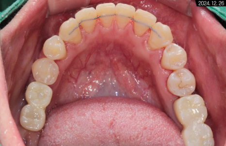 돌출입 및 신경치료와 임플란트 식립 동시 진행 증례 관련 이미지 27