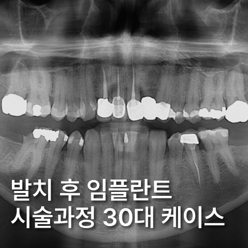신사역치과 발치후 임플란트 시술과정 30대 남성 케이스 관련 이미지 1