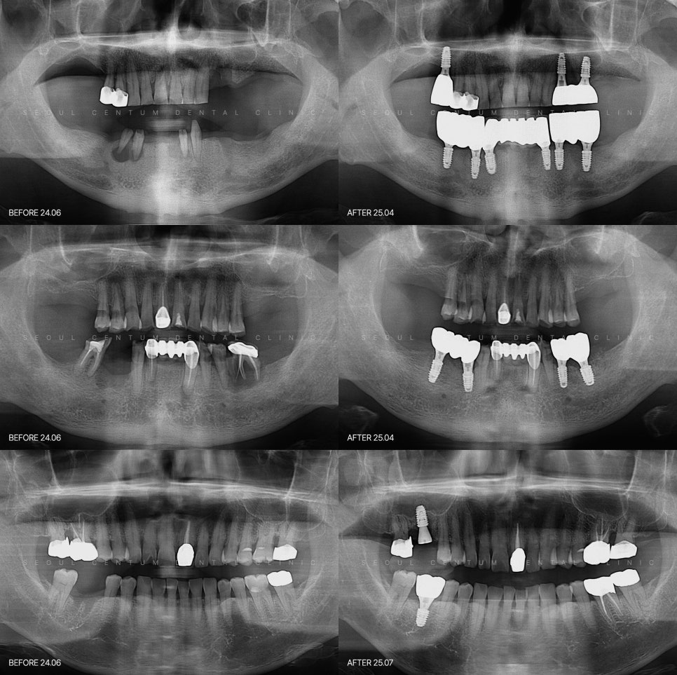 임플란트 가격비교사이트 기준점 총정리 해드립니다 관련 이미지 6