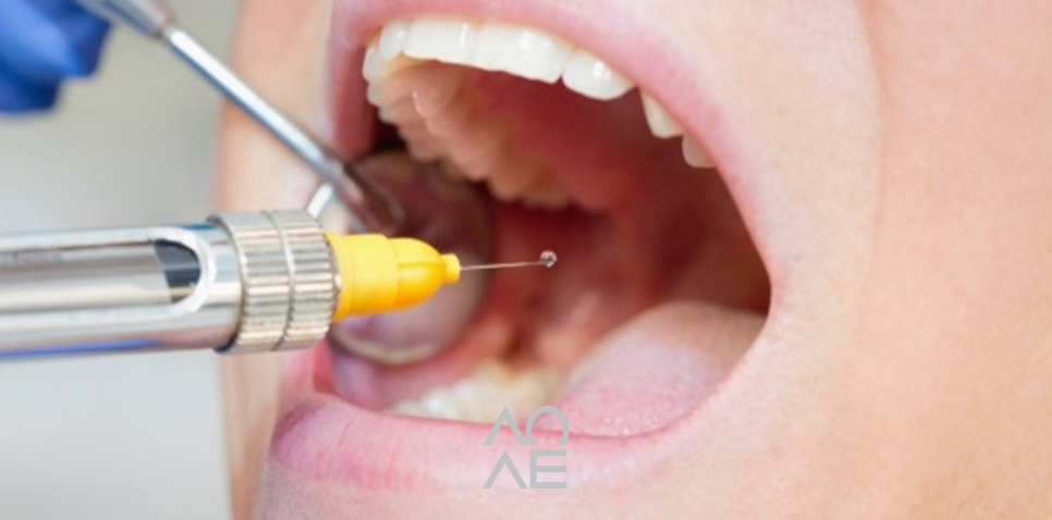 치과 마취 종류 풀리는 시간 주의사항에 대해서 관련 이미지 4