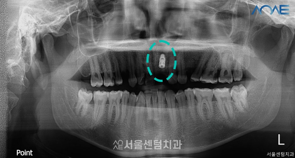 당일임플란트 상담부터 풀과정 공개 관련 이미지 3