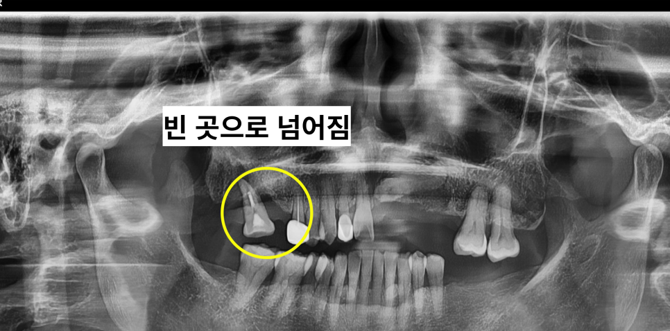 발치 후 임플란트 꼭 해야하는 이유 (잇몸뼈 소실, 쓰러짐, 정출) 관련 이미지 6