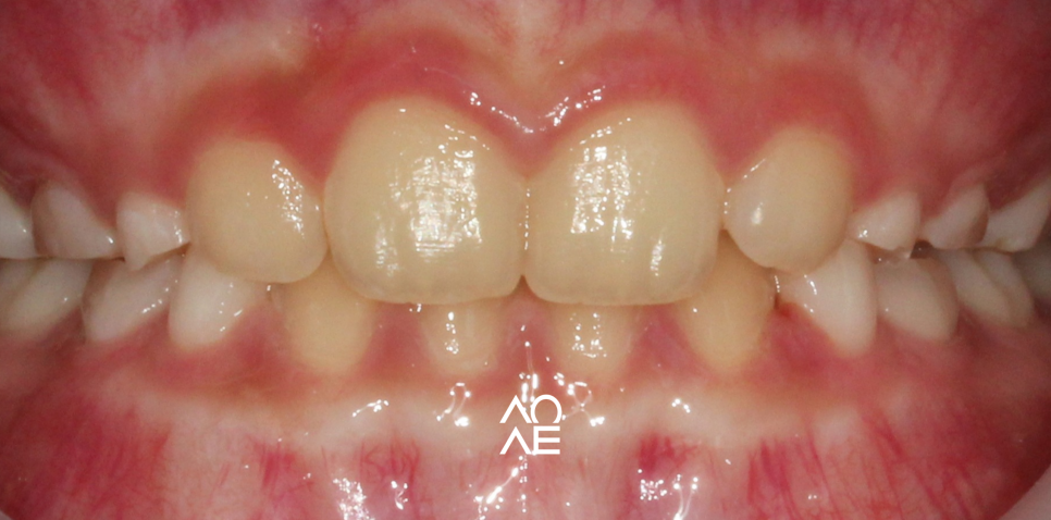 주걱턱 교정, 페이스마스크 활용 주의사항 관련 이미지 6