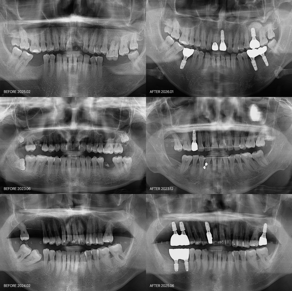 당뇨임플란트 가능 여부 관련 고찰 고혈압 동반 환자는 어떻게 관련 이미지 6