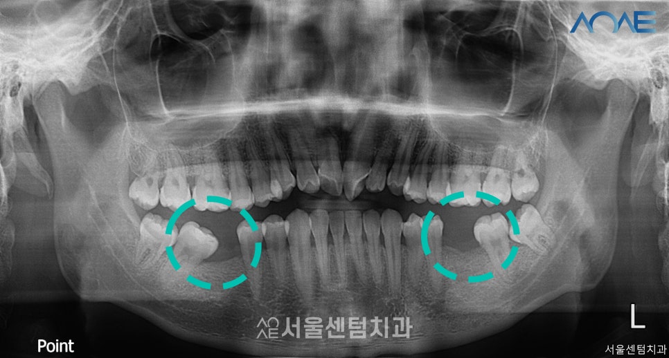 교정임플란트 모두 맡겨주신 결과 관련 이미지 1