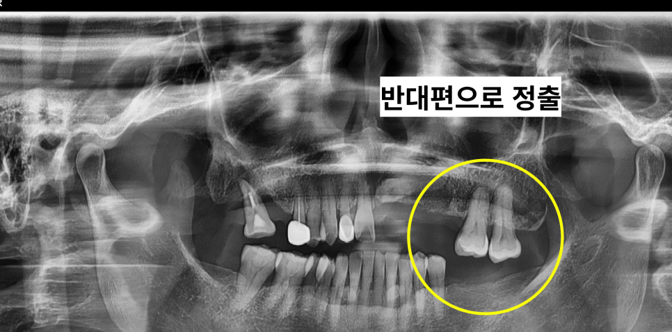 발치 후 임플란트 꼭 해야하는 이유 (잇몸뼈 소실, 쓰러짐, 정출) 관련 이미지 2