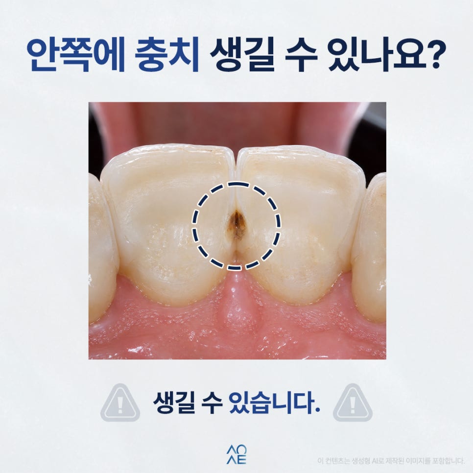 라미네이트 수명 언제까지 몇년 유지가 가능한건가요? 평생도 가능한가요? 관련 이미지 5
